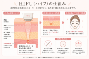 HIFU(ハイフ)の仕組みを示した図解