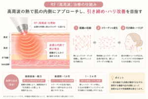 RF(高周波)治療で皮膚の内側に熱を加え、引き締めやハリ改善を目指す仕組みの図解
