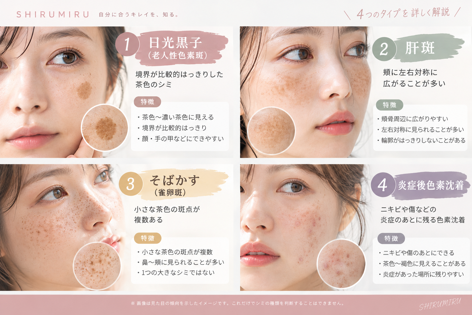 代表的なシミ4タイプの特徴と見分け方を比較した図