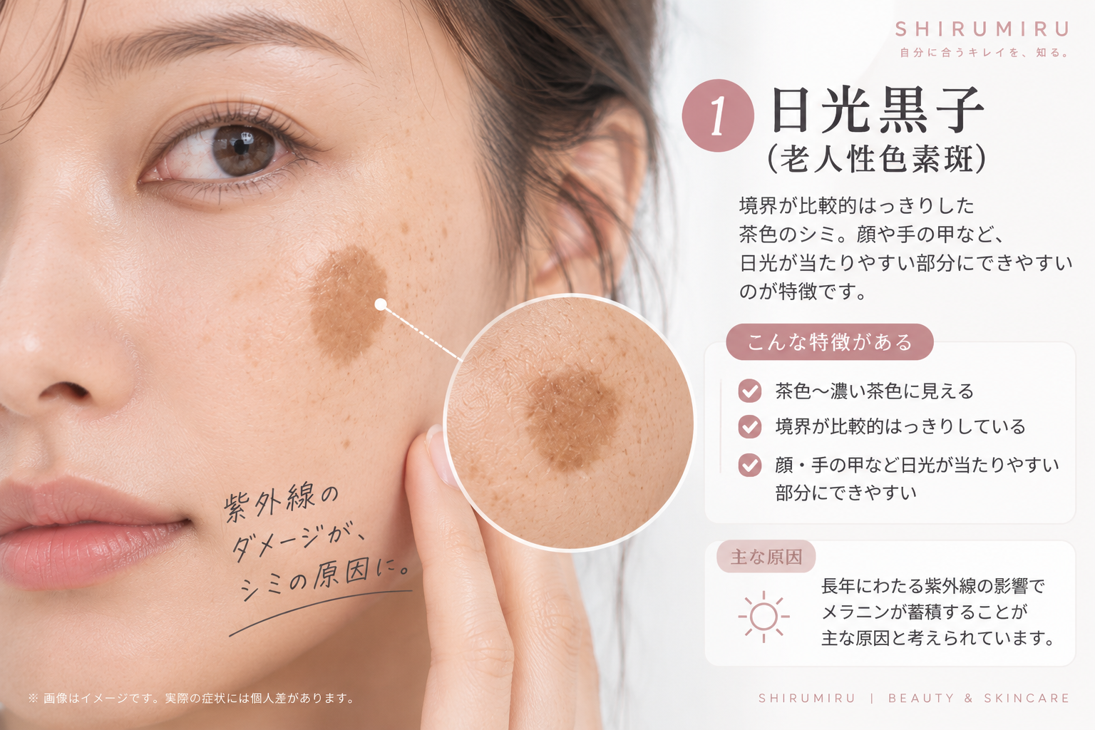 日光黒子（老人性色素斑）の特徴を示した肌のイメージ
