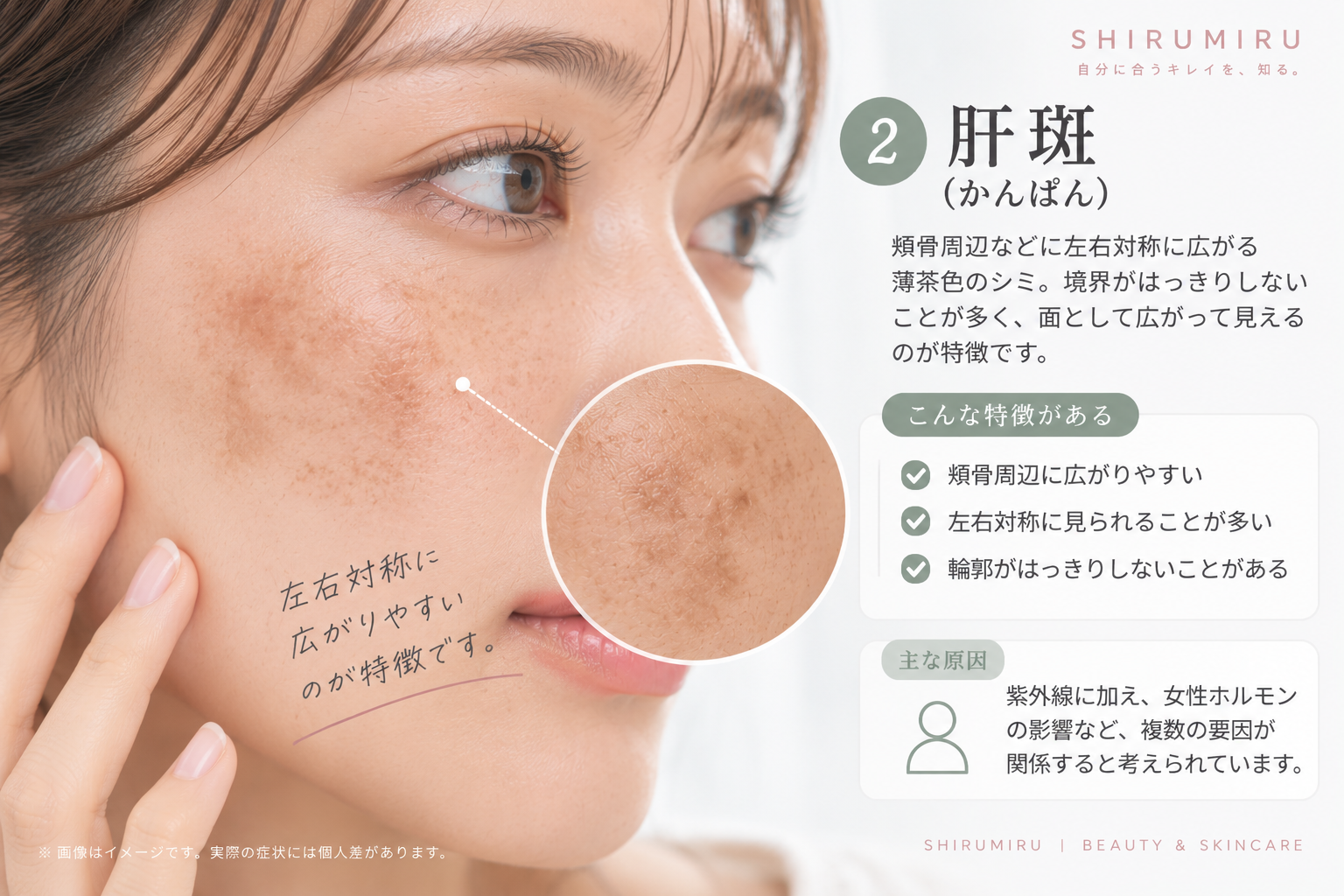 肝斑の特徴を示した頬の色素斑のイメージ