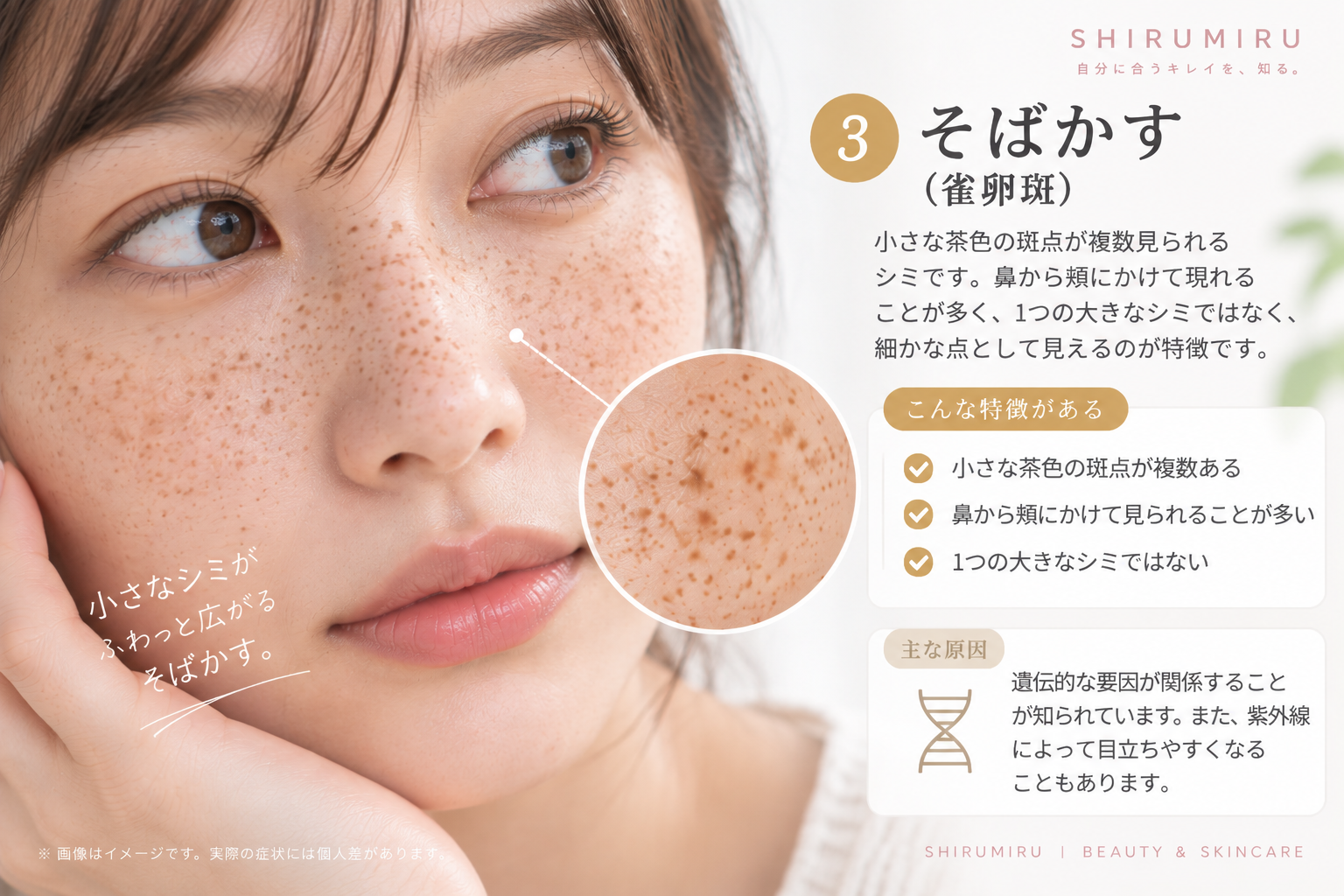 ニキビなどの炎症後色素沈着の特徴を示した肌のイメージ