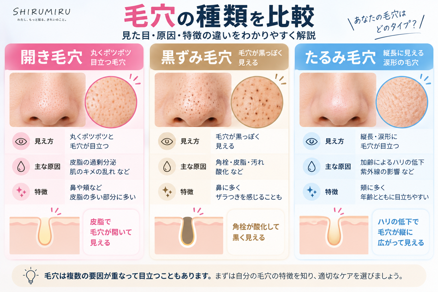 開き毛穴・黒ずみ毛穴・たるみ毛穴の違いを比較した図